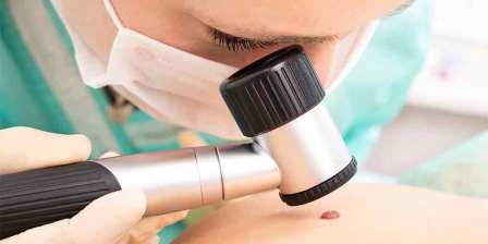 doctor checks mole for skin cancer