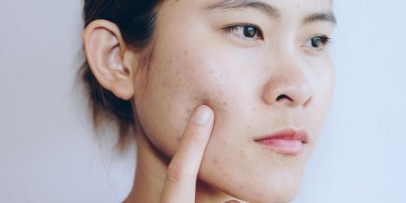 young woman with acne