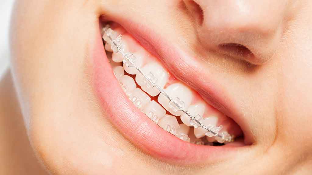 girl with braces